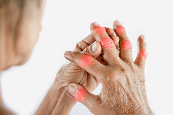Exploring the Various Forms of Arthritis and Their Impact on Health